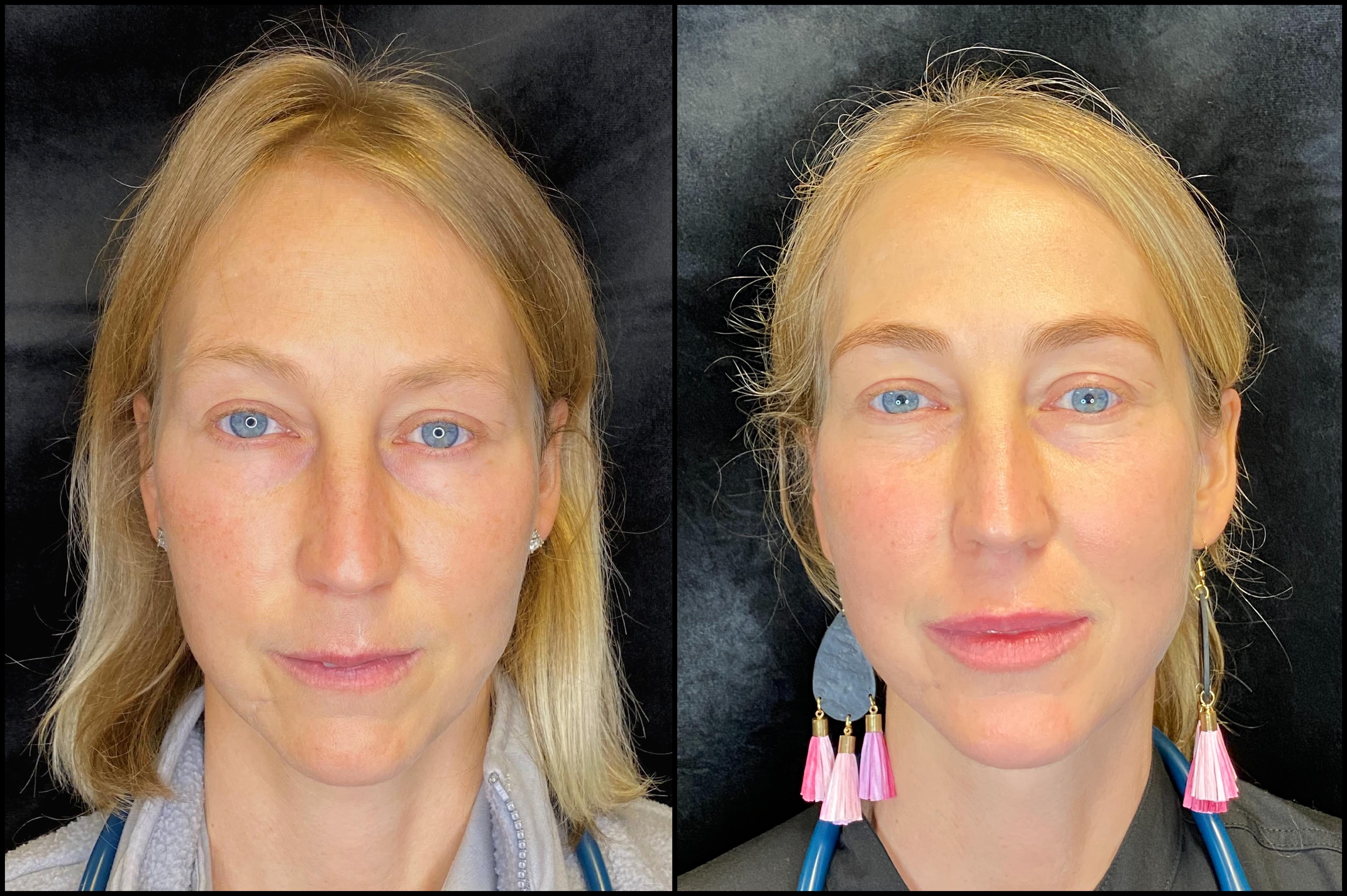 Ipl foto facial